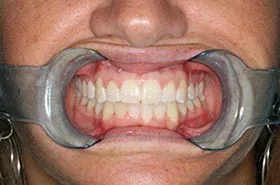 6 Month Smiles in Powell TN