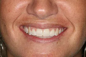 6 Month Smiles Powell TN