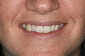 6 Month Smiles Powell TN