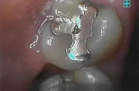 Dental Fillings Powell TN