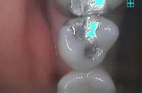 Dental Fillings 37849