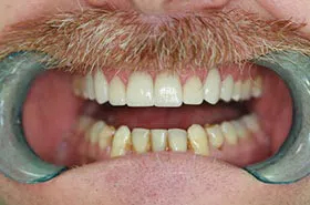 Powell TN Dental Veneers