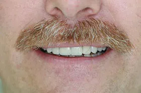 Dental Veneers in Powell TN