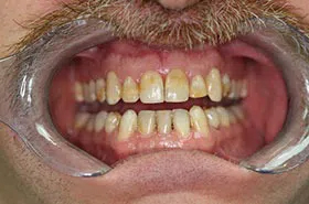 Dental Veneers in Powell TN