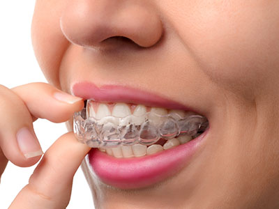 Kennedy Dentistry | Preventative Program, Invisalign reg  and Oral Exams