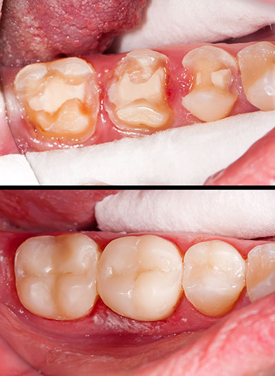 Kennedy Dentistry | Dental Sealants, Ceramic Crowns and Cosmetic Dentistry